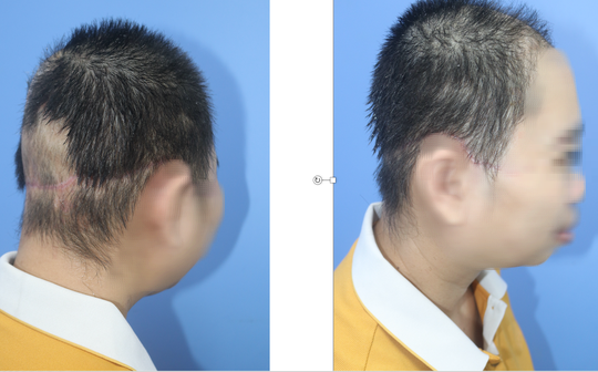 Người phụ nữ bay mất toàn bộ da đầu trong lúc phụ chồng khoan giếng - Ảnh 3.