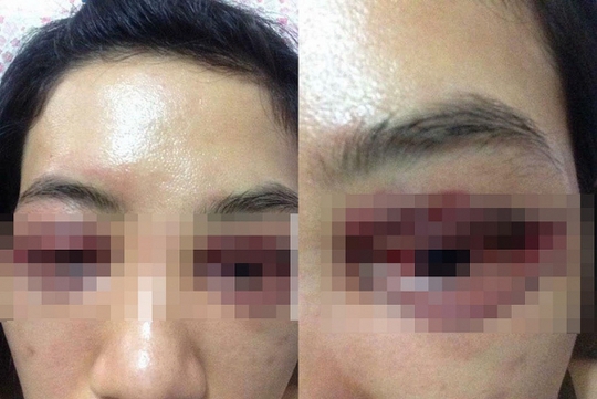 Suýt hỏng mắt vì làm mẫu cho học viên spa cắt mí - Ảnh 2.