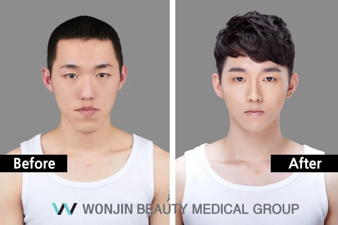 2 idol Kpop được coi là hình mẫu phẫu thuật thẩm mỹ của nam giới - Ảnh 1.