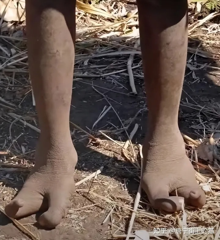Bí ẩn về bộ tộc 'đà điểu': Không thể đi giày vì thiếu ngón chân!
