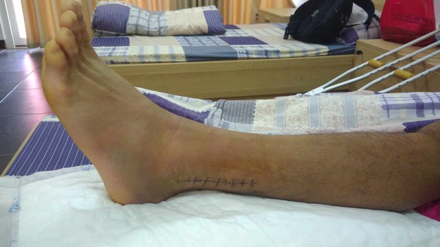 Đôi chân mang 6 chiếc đinh và màn lột xác ngoạn mục của tiền vệ Việt Nam từng dự U20 World Cup - Ảnh 2.