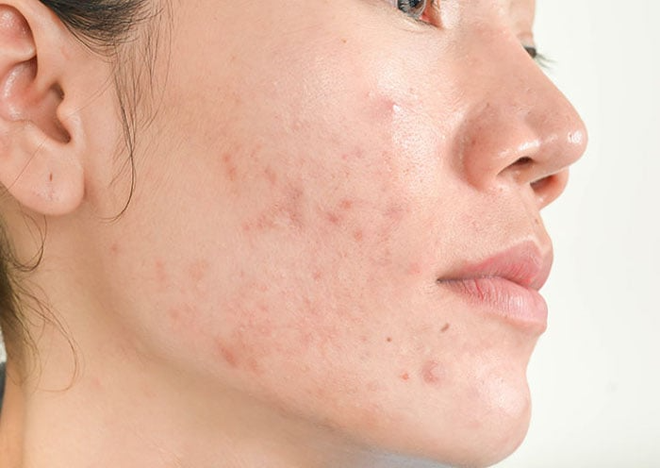 Tẩy da chết: Bí quyết cải thiện làn da sần sùi, thâm sạm của phụ nữ tuổi 30 - Ảnh 1.