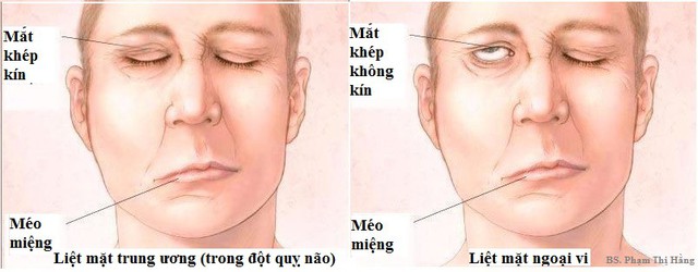 Trúng gió và đột quỵ não thường bị nhầm lẫn, phân biệt ra sao để có cách xử trí đúng? - Ảnh 2.