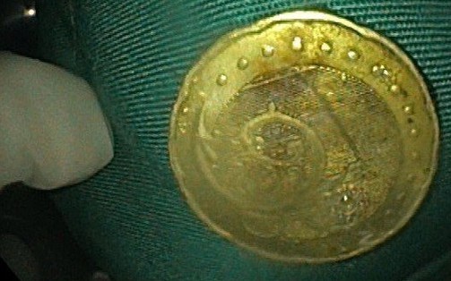 Ớn lạnh đồng xu mắc kẹt trong thực quản của bé gái 5 tuổi