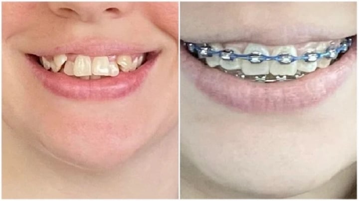 20 bức ảnh chứng minh niềng răng thay đổi nụ cười của bạn ra sao - Ảnh 11.