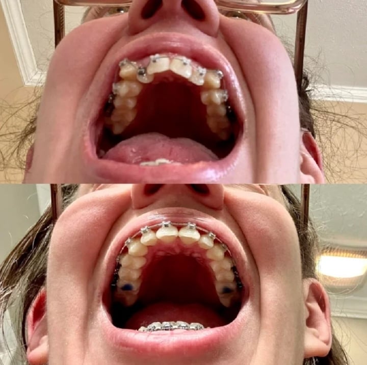 20 bức ảnh chứng minh niềng răng thay đổi nụ cười của bạn ra sao - Ảnh 10.