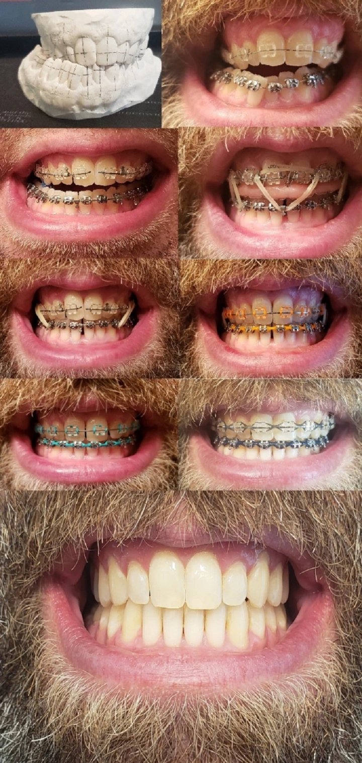 20 bức ảnh chứng minh niềng răng thay đổi nụ cười của bạn ra sao - Ảnh 19.