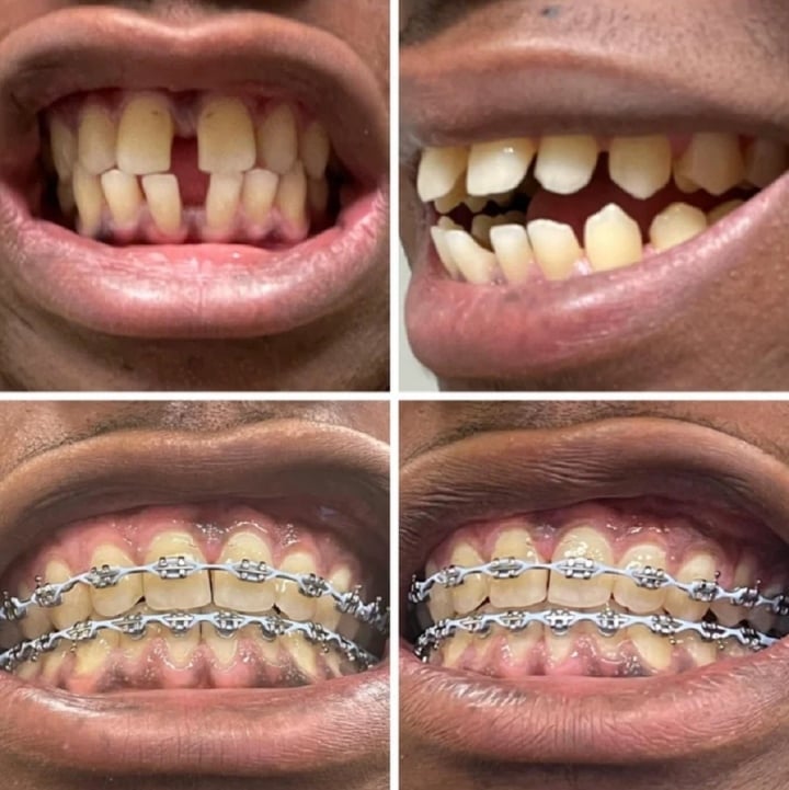 20 bức ảnh chứng minh niềng răng thay đổi nụ cười của bạn ra sao - Ảnh 15.