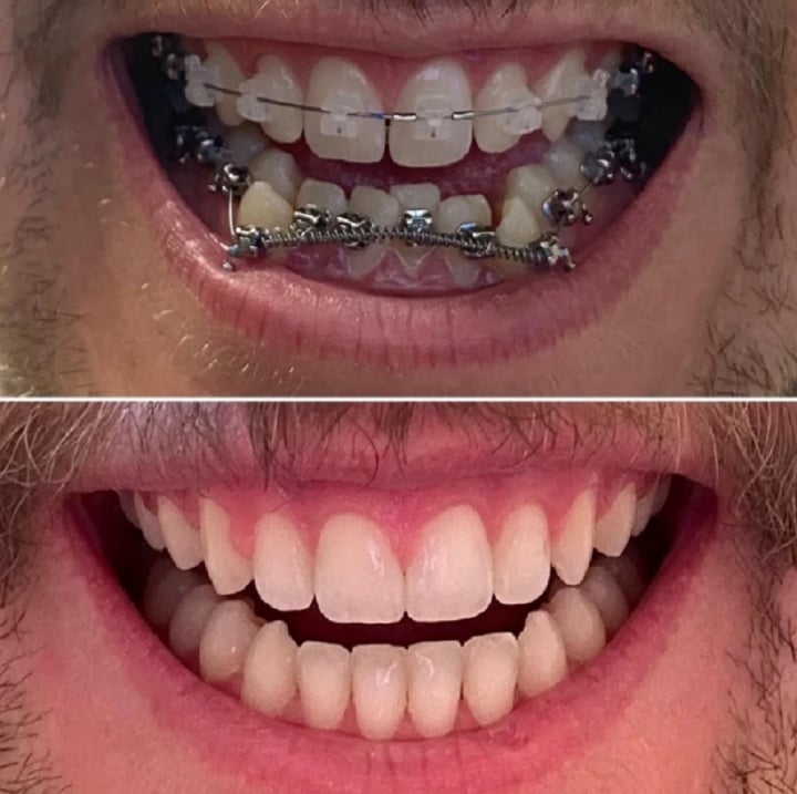 20 bức ảnh chứng minh niềng răng thay đổi nụ cười của bạn ra sao - Ảnh 14.