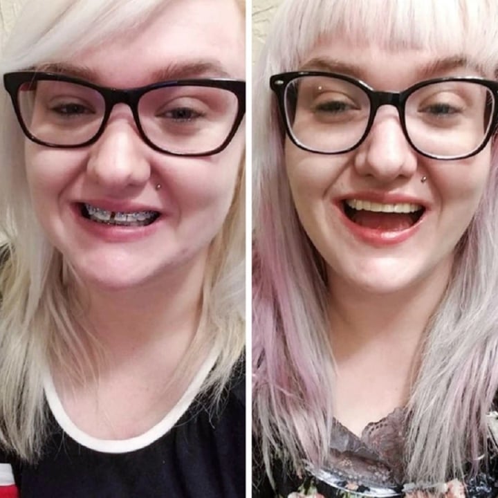 20 bức ảnh chứng minh niềng răng thay đổi nụ cười của bạn ra sao - Ảnh 13.
