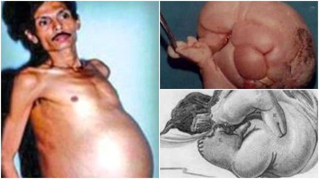 Người đàn ông mang 'bào thai chết lưu' suốt 36 năm, thai nhi nặng 4kg, có tóc và chân tay