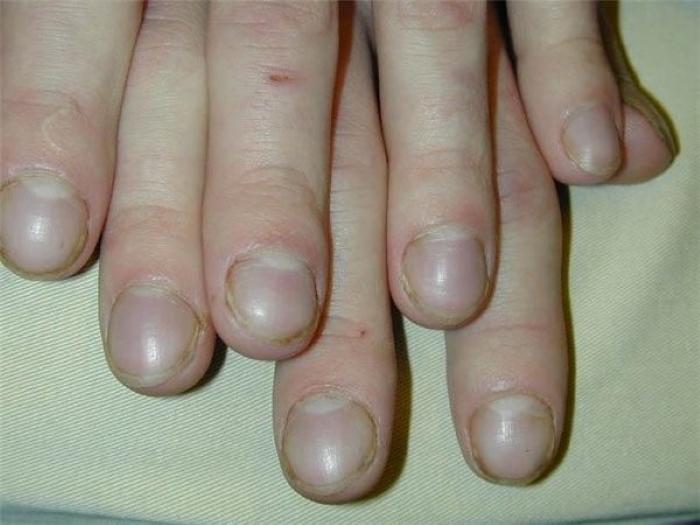 4 dấu hiệu ở ngón tay cho thấy chất độc tích tụ, cần sớm tầm soát ung thư gan và phổi - Ảnh 3.