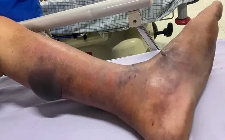 Nhiễm liên cầu lợn sau khi ăn tiết mua ngoài chợ- Ảnh 1.