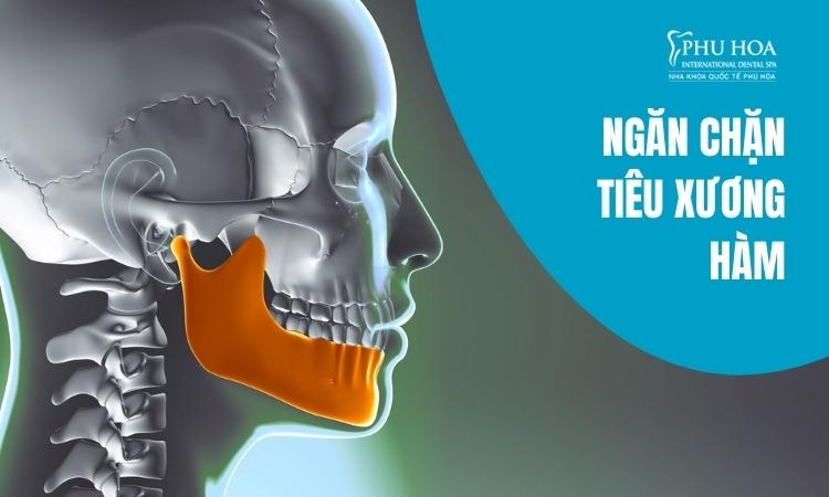 Công nghệ trồng răng implant vượt trội tại Nha khoa Quốc tế Phú Hòa- Ảnh 3.