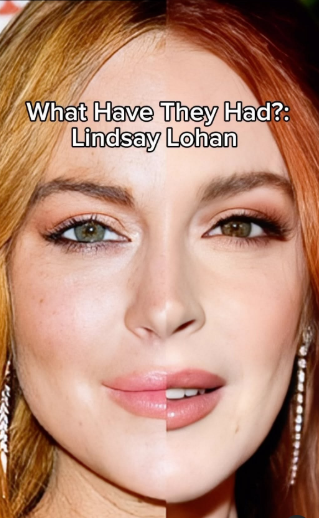 Bí ẩn của "thần dược cải lão hoàn đồng": Cách Lindsay Lohan và loạt sao Hollywood sử dụng để cứu vớt nhan sắc tới ngày "cận date"?- Ảnh 9.