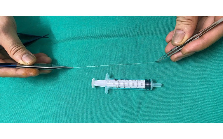 B&aacute;c sĩ gắp con giun d&agrave;i 14 cm k&yacute; sinh trong mắt người phụ nữ ở Thanh H&oacute;a- Ảnh 1.