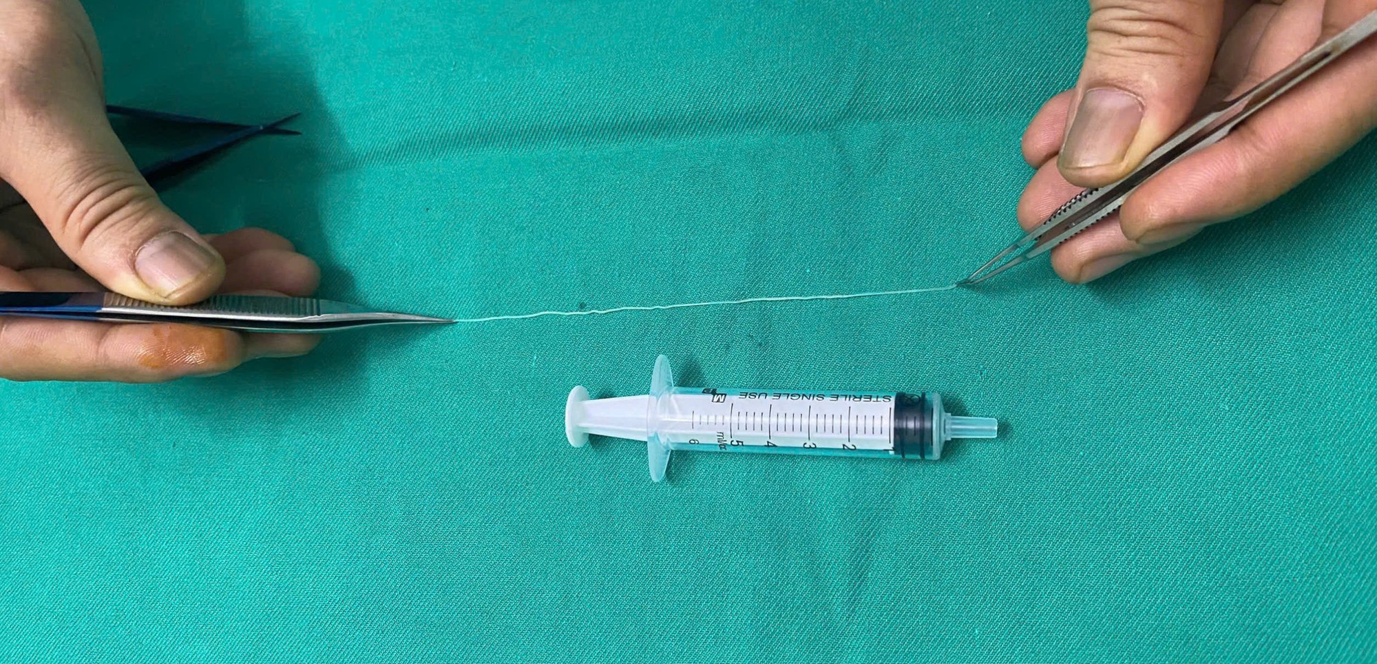 B&aacute;c sĩ gắp con giun d&agrave;i 14 cm k&yacute; sinh trong mắt người phụ nữ ở Thanh H&oacute;a- Ảnh 3.