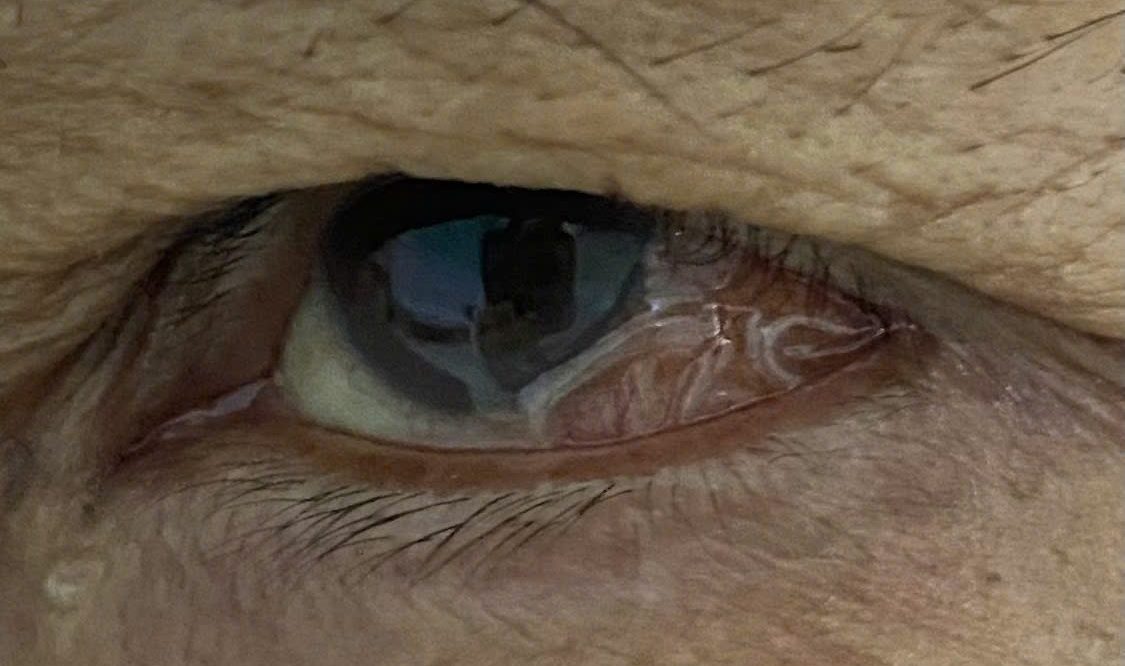 B&aacute;c sĩ gắp con giun d&agrave;i 14 cm k&yacute; sinh trong mắt người phụ nữ ở Thanh H&oacute;a- Ảnh 2.