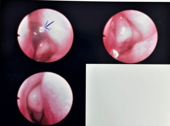 Bé gái 13 tháng tuổi ở Bình Thuận khóc dữ dội sau khi tắm suối, gia đình tá hỏa khi thấy sinh vật lạ lấp ló trong lỗ mũi - Ảnh 1.