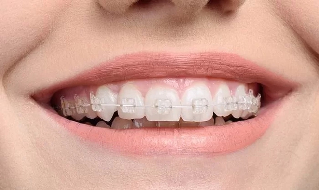Niềng răng để đều như hạt bắp, khuôn mặt cân đối: Có 5 kiểu cho bạn lựa chọn! - Ảnh 3.