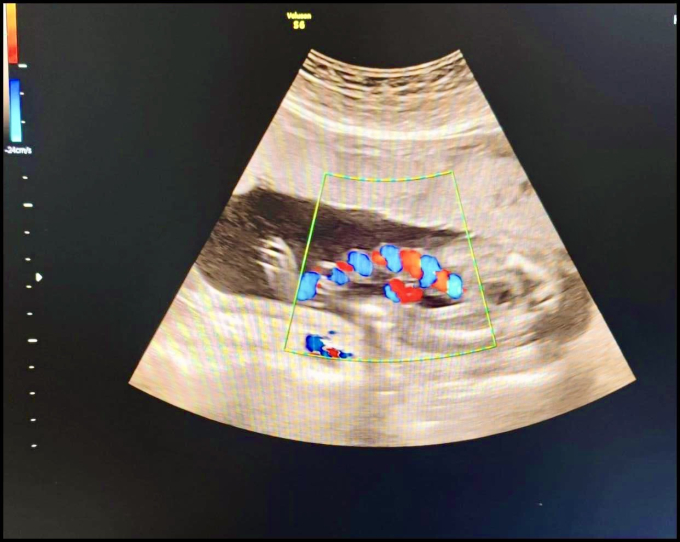 Sản phụ 20 tuổi chuyển dạ, bác sĩ siêu âm giật mình trước hình ảnh bất thường của dây rốn: Mổ lấy thai khẩn cấp! - Ảnh 2.
