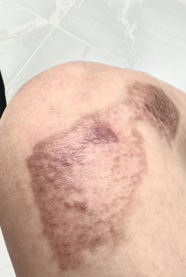 Sau 1 tháng điều trị, Ngọc Trinh tiết lộ hình ảnh vết thương do tai nạn khi diễn xiếc trên mô tô để lại - Ảnh 3.