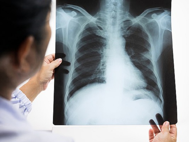 Gia đình có 3 người đàn ông cùng mắc ung thư phổi - Hình 2