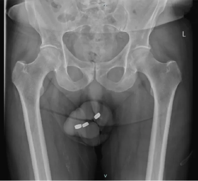 Xem ảnh X-quang của nam bệnh nhân, bác sĩ sốc khi phát hiện dị vật ở chỗ không ngờ - Ảnh 2.
