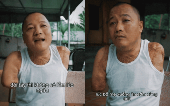Người đàn ông bị điện giật phải cắt cụt tay chân, cay đắng khi vợ bỏ đi không lời từ biệt: Phải nhờ bố mẹ xúc cho từng miếng cơm - Ảnh 1.