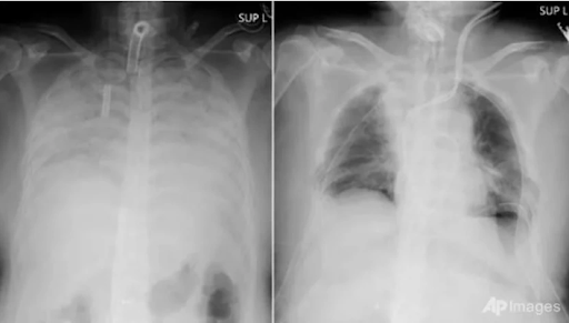 Chụp X-quang phát hiện nhiều người trẻ phổi trắng xóa, nguyên nhân vì đâu? - Ảnh 2.