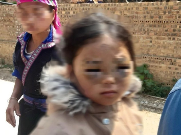 Vụ bé lớp 1 ở Yên Bái bị đánh tím mắt: Thông tin bất ngờ về cô giáo - Ảnh 2.