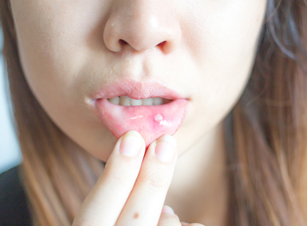 3 bất thường ở khoang miệng là cảnh báo sớm khi tế bào ung thư tấn công cơ thể - Ảnh 2.