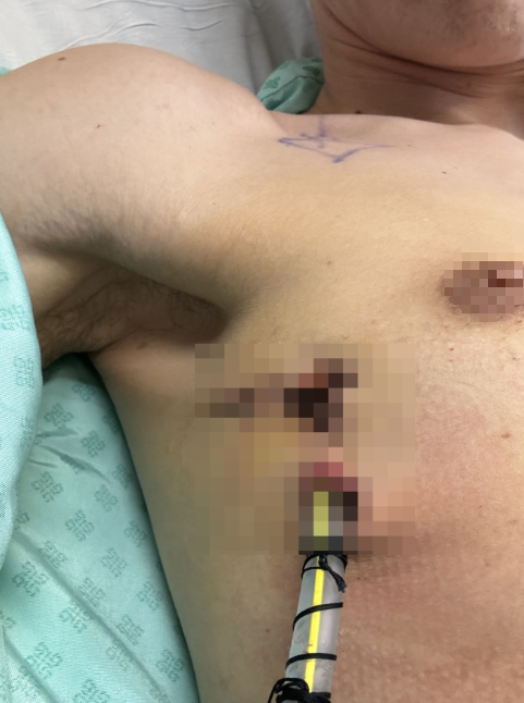 Thanh niên 29 tuổi đang khỏe bỗng ngã quỵ, ngực đau như bị đâm: Bác sĩ nói do 1 thói quen cực có hại - Ảnh 3.