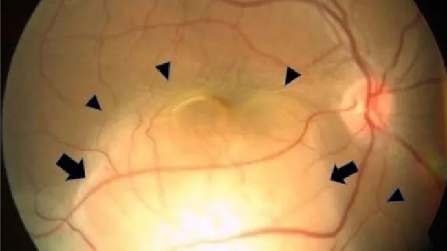 Người phụ nữ phát hiện ung thư phổi ẩn giấu nhờ 1 dấu hiệu ở mắt - Ảnh 1.