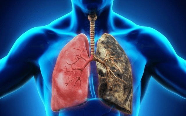 Tưởng chỉ cảm lạnh, người đàn ông bất ngờ nhận tin ung thư phổi: Triệu chứng cảnh báo hơn 1 tuần nhưng bị bỏ qua - Ảnh 2.
