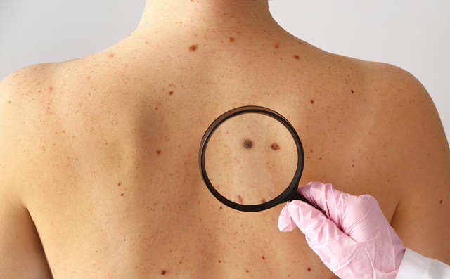 Rùng mình trước clip mô tả dấu hiệu cảnh báo ung thư ác tính, có thể xuất hiện trên da trước 10 năm - Ảnh 2.