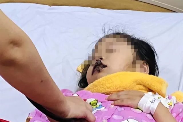 Nhầm tưởng là đường ăn, bé 5 tuổi nhập viện do nuốt xút ăn da - Ảnh 1.