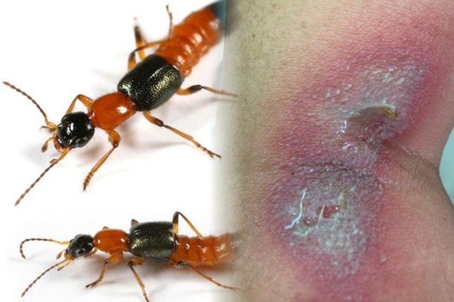 Bác sỹ cảnh báo vết đốt nhỏ từ côn trùng cũng có thể gây chết người - Ảnh 3.