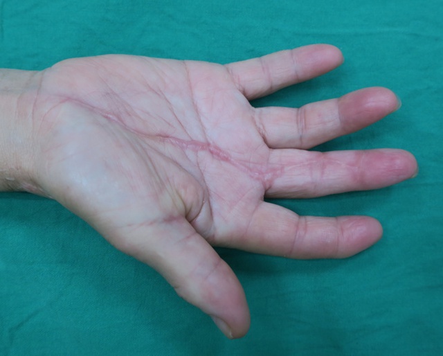 Người phụ nữ suýt phải cắt cụt ngón tay vì mắc 1 sai lầm khi lau nhà: Bác sĩ cảnh báo nguy cơ - Ảnh 3.