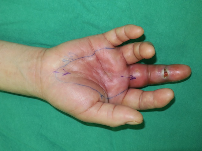 Người phụ nữ suýt phải cắt cụt ngón tay vì mắc 1 sai lầm khi lau nhà: Bác sĩ cảnh báo nguy cơ - Ảnh 2.