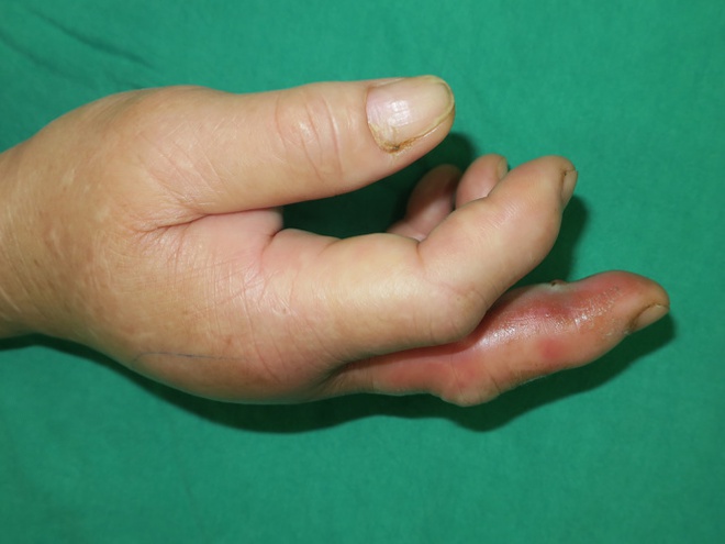 Người phụ nữ suýt phải cắt cụt ngón tay vì mắc 1 sai lầm khi lau nhà: Bác sĩ cảnh báo nguy cơ - Ảnh 1.