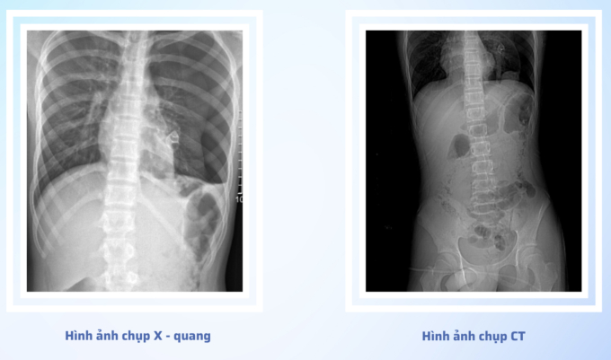 5 giờ phẫu thuật cho thiếu niên 15 tuổi bị cành cây đâm xuyên vùng hậu môn khi nhảy xuống ao tắm - Ảnh 1.