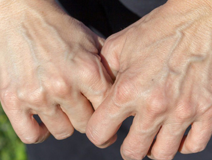 Nếu trên tay không có 5 đặc điểm này chứng tỏ bạn may mắn sở hữu lá gan khỏe mạnh - Ảnh 3.