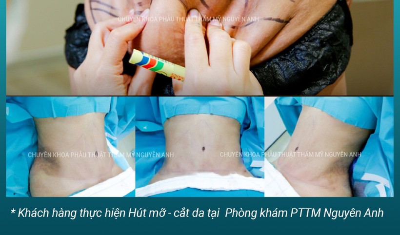 45 phút sau hút mỡ, một người phụ nữ nhồi máu não - Ảnh 1.