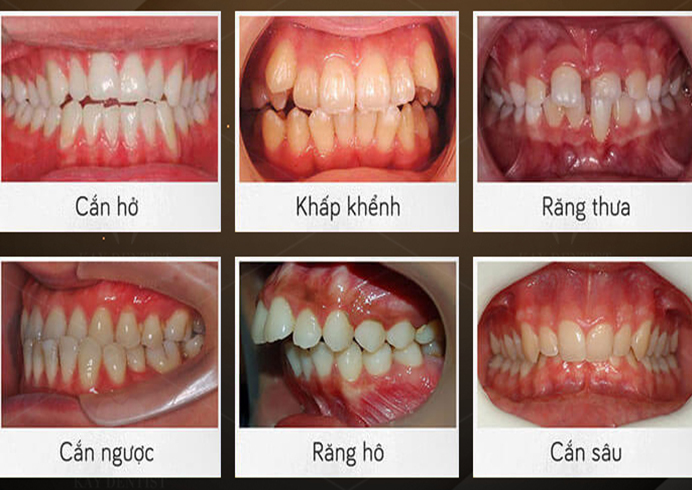 Những người sở hữu 7 đặc điểm này nên niềng răng càng sớm càng tốt