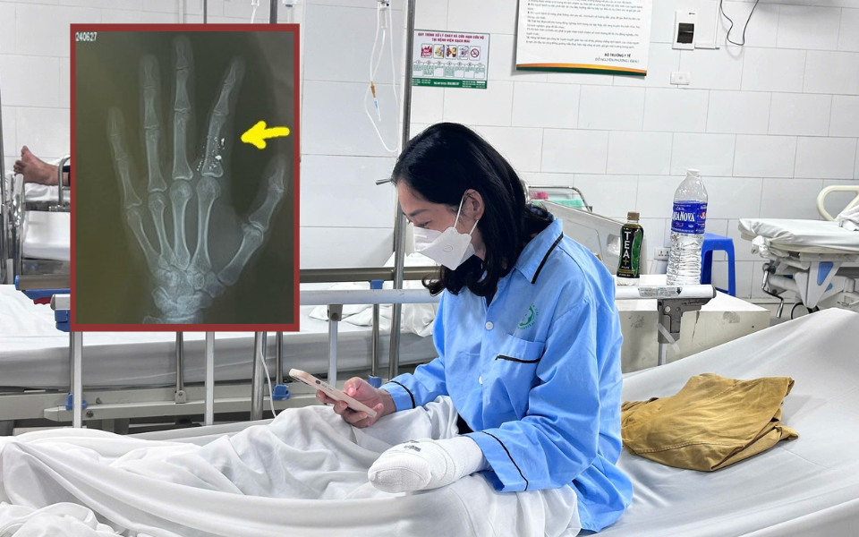 Ảnh chụp X-quang của 1 trường hợp bị nhiễm độc thủy ng&acirc;n do l&agrave;m vỡ nhiệt kế khiến nhiều người sởn da g&agrave; - Ảnh 6.