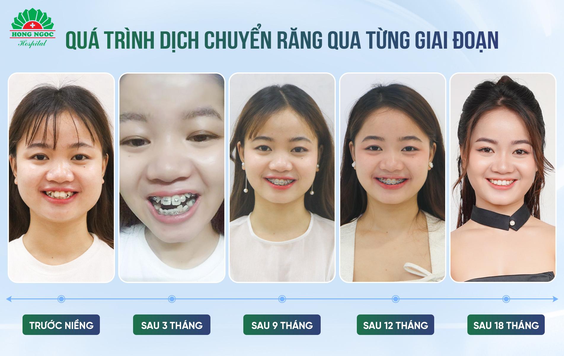 Niềng răng có thể thay đổi được gương mặt?- Ảnh 2.