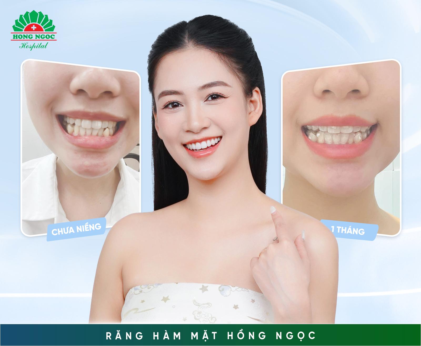 Niềng răng có thể thay đổi được gương mặt?- Ảnh 5.