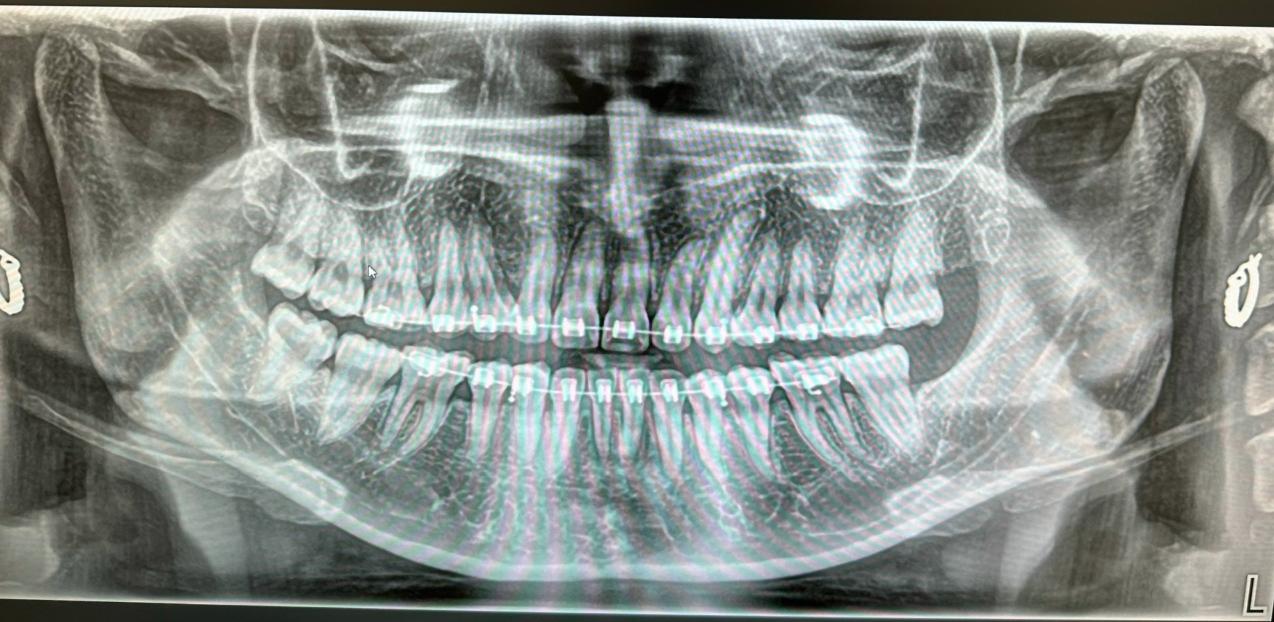 Câu chuyện về cô gái niềng răng hỏng và hành trình 12 năm tìm lại nụ cười tự tin- Ảnh 3.