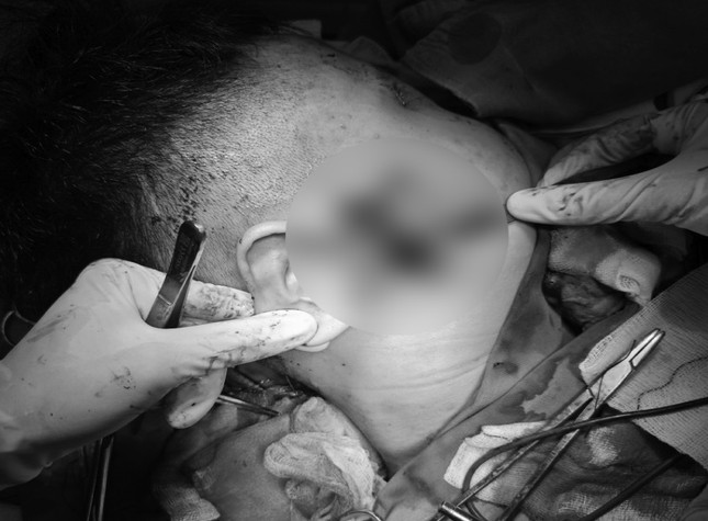 Thanh niên bị đâm dao vào mặt đứt nhiều động mạch, máu phun thành vòi- Ảnh 1.